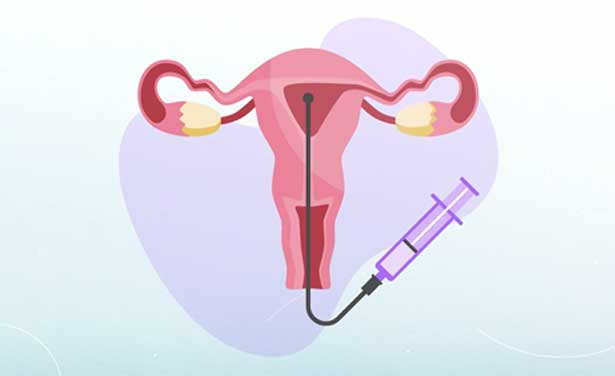 Uttar Vasthi (special enema administered through urethral or vaginal routes) 